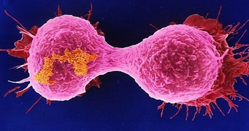 Breast cancer facts: abnormal cells